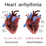 Arrhythmia versus dysrhythmia — home remedies for heart palpitations