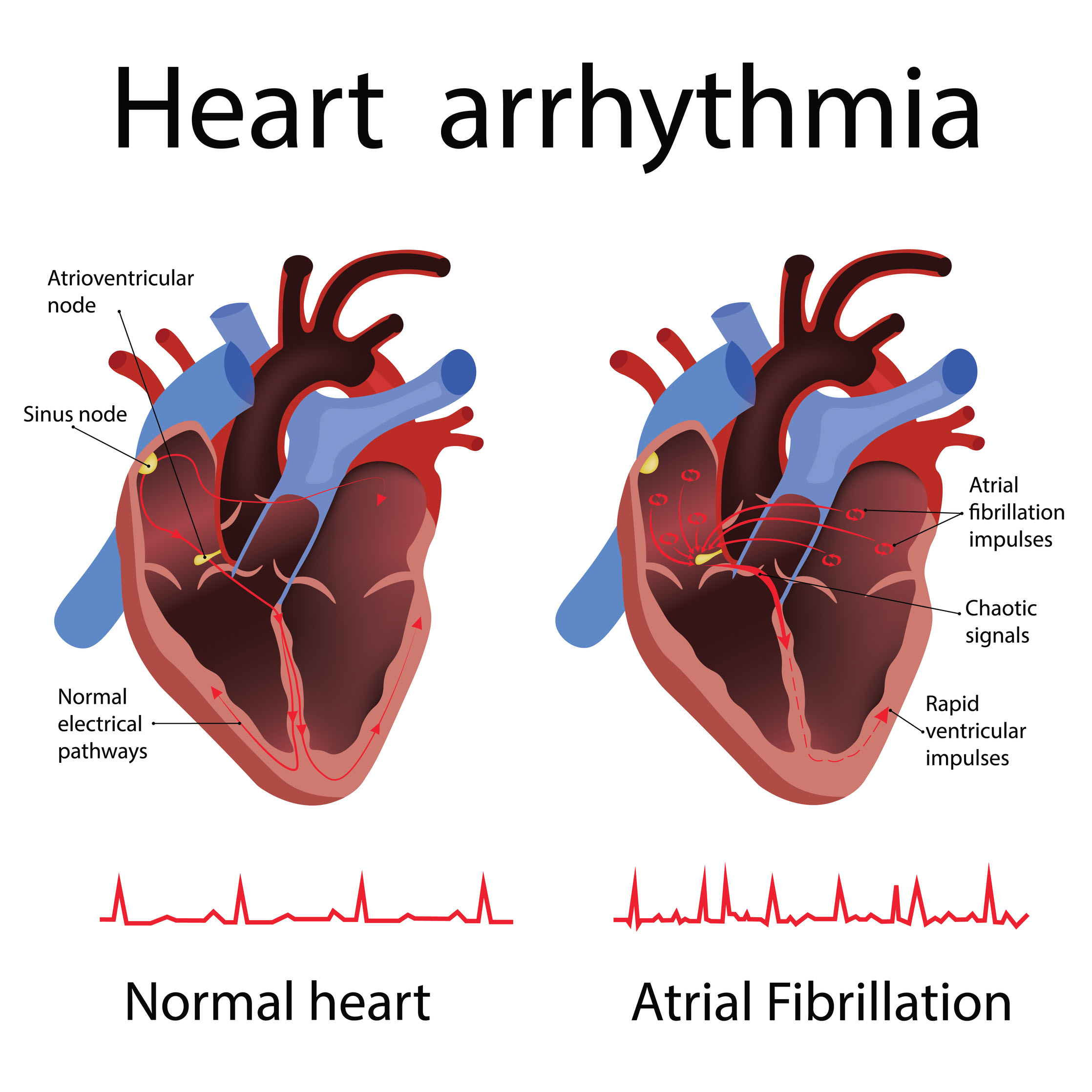 Arrhythmia versus dysrhythmia — home remedies for heart palpitations