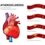 Atherosclerosis symptoms — reverse heart blockage naturally