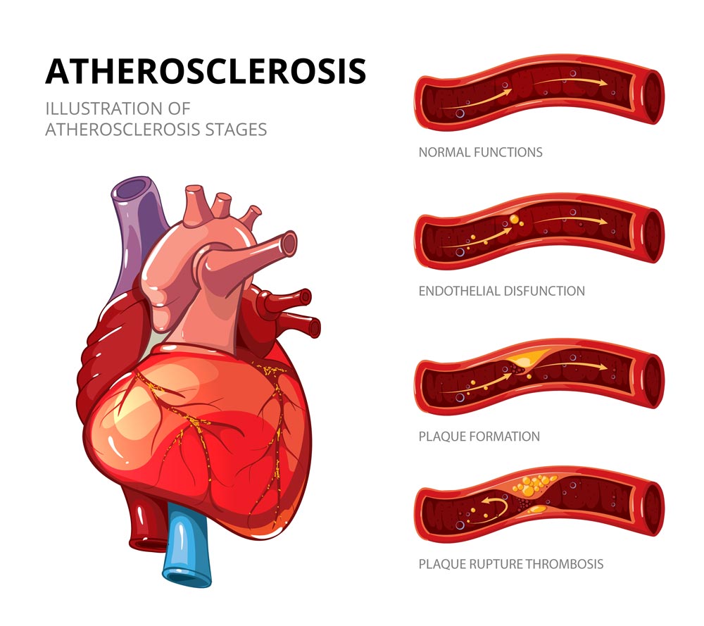 Atherosclerosis symptoms — reverse heart blockage naturally