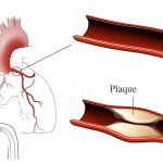 Coronary heart disease — can heart blockage be reversed