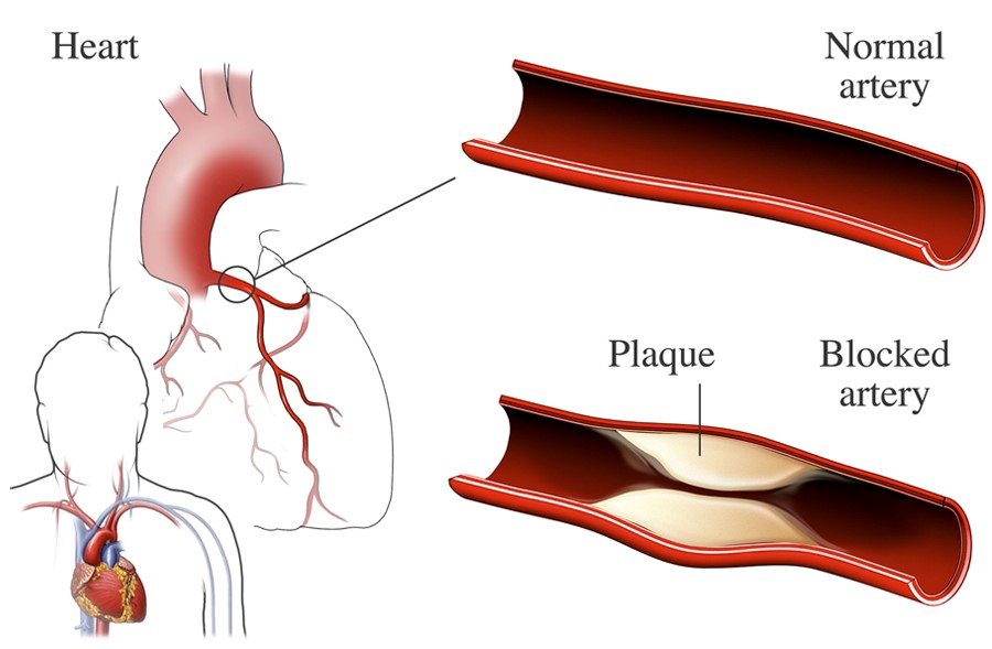 Coronary heart disease — can heart blockage be reversed